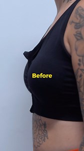 Beautiful results !! Trust the process ! We can’t wait to see this patient final results !!! ✨ DM us for your free consultation!! | CG Cosmetic Surgery | Facebook