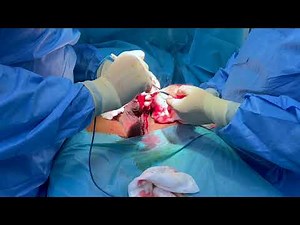 SPECTACULAR CASE OF PENILE LENGTHENING AND THICKENING AND FIBROSIS REMOVAL WITH HYALURONIC ACID