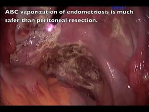 Endometriosis / Infertility / Argon Beam Coagulation