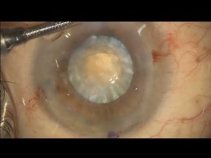 Phacoemulsification in hard mature cartaract with weak zonules