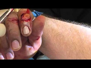 Hypothenar Graft For Distal Finger Avulsions