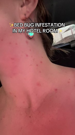 Bed Bugs in Paris Hotel: A Disappointing Experience