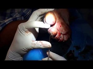 Myiasis - Maggots (Larva) crawling out of wound