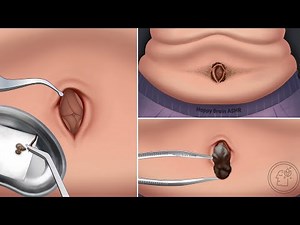 ASMR | Deep Belly Button Cleaning | Remove Huge Navel Stone and Dirt Removal Animation