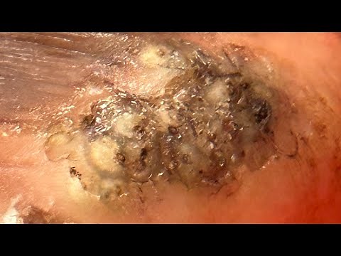 Jigger digging Veronica - see ongoing jigger digging videos @riseupsociety.net (SUBSCRIBE PLEASE)