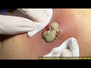 Squeezing a giant abscess - Pus spurts out like a volcano.