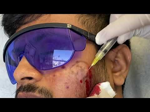 Subcision for Acne Scars