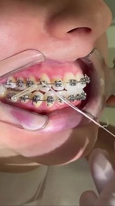Orthodontic rubber bands 醴✨ Wearing rubber bands improves the fit of your upper and lower teeth and/or jaws - the bite. Rubber bands align your bite and are very important for the bite-fixing phase of orthodontic treatment, which is usually the longest and most difficult part of the whole process. . Case by @amabileodontologia | Dentistry blog | Facebook