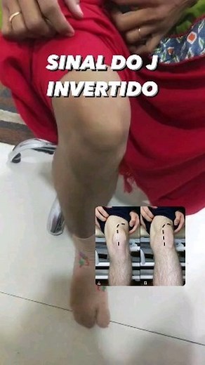 5.3K views · 15 reactions | O sinal J refere-se à faixa ‘J’ invertida que a patela leva da extensão à flexão precoce (ou vice-versa) em uma patela mal-incada. A patela subluxada lateralmente de repente muda medialmente à medida que se envolve no sulco troclear do fêmur distal. O sinal J no exame clínico é sugestivo de mal-rastreamento patelar e potencial instabilidade. Retirado de @pontodafisioterapia | Diário de um Fisioterapeuta | Facebook