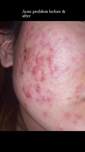 Acne before & after #acnetreatment #acne #foryou | Jess
