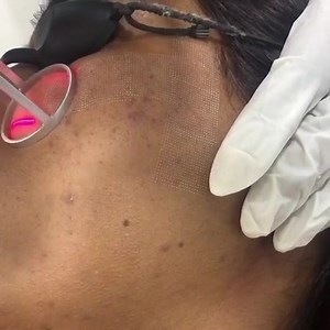 #drvenus #acnescartreatment #co2laser | Dr.Venus Institute Of Skin, Hair, Aesthetics & AntiAging