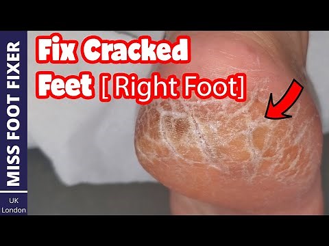 Fix Cracked Feet : Cracked Heel Skin Removal Full Treatment By Miss Foot Fixer [ Right Foot]