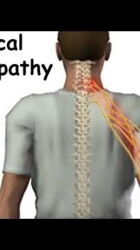 C5-C6-C7 ( Nerves compression ) patient recovery feedback