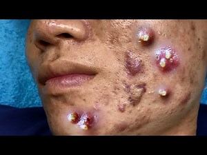 Acne, Zit & Pimple Removal | Blackhead Extraction | Abscess Drainage | Cyst Popping this week #4