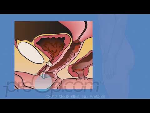 Mesh Sling For Stress Urinary Incontinence Surgery