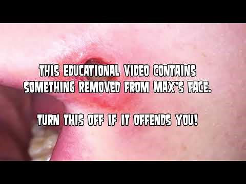 Cyst or Bot Fly?! What is on Max's Face?? Mystery Diagnosis