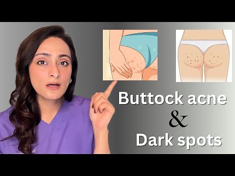 How to treat buttock acne and dark spots on buttocks | dermatologist suggests