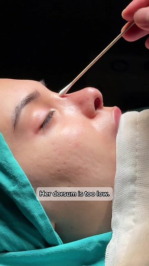 Understanding Reconstruction Rhinoplasty Techniques