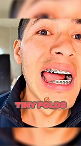 204K views · 368 reactions | His Tongue Got Stuck in Braces 醴 #DidYouKnow #explain #braces #bracesjourney | Charlie Rivera | Facebook