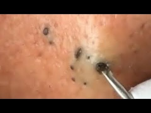 CYST POP AND HUGE BLACKHEAD Removal Videos 2020