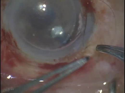 Anterior Chamber IOL Exchange and DSAEK Procedure With Pseudophakic Bullous Keratopathy - Eyetube