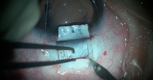 360-Degree Trabeculotomy With Deep Sclerectomy for Pediatric Glaucoma - Eyetube