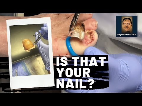 ENTIRE NAIL REMOVED Permanently