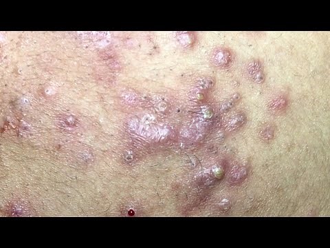 THE BEST INFLAMED BLACKHEADS FIELD | Suri Job 115