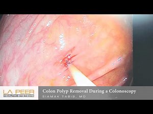 Colon Polyp Removal During Colonoscopy | Los Angeles La Peer Surgery Center