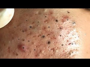 Blackhead Extractions | Blackheads Removal | Acne Treatment | Cystic Acne Extraction