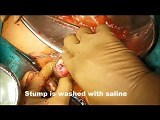 Partial Penectomy for Penile Cancer • Video • MEDtube.net