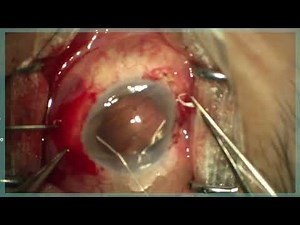 Artificial Iris Implant Restores Visual Function