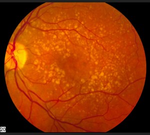 Photovoltaic polymer restores some vision to rats with retinal degeneration