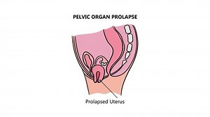 Prolapsed Uterus Women Animated Medical Education Stock Footage Video (100% Royalty-free) 3658885325 | Shutterstock