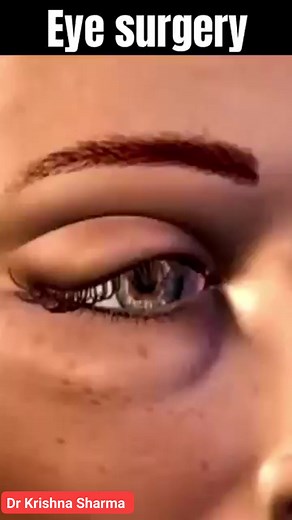 3D Animation of eye surgery #reels #viral #viralreels #treanding #shorts #short #instagram #drkrishnasharma | Drx Krishna Sharma