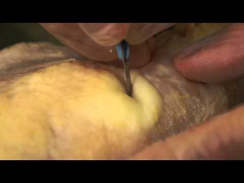 Understand Wound Care: Incision & Drainage Demonstration