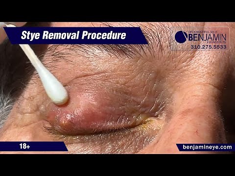 Effective Stye Removal Procedure at Benjamin Eye Institute