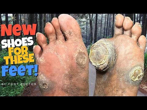 New Shoes For These Feet: Therapeutic Shoes For An At Risk Diabetic