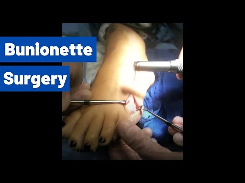 Bunionette Surgery (Tailor's Bunion) | Moore Foot & Ankle Specialists
