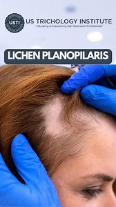 Progressive Hair Loss: Unraveling Lichen Planopilaris . . #hairstyle #shampoo #hairloss #conditioner #hairtransplant #hairtransplantation #hair #trichologist #trichology #alopecia | United States Trichology Institute