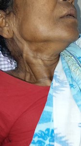 Cardinal Sign of Right Heart Failure | Dr. Khaled Hasan Milu