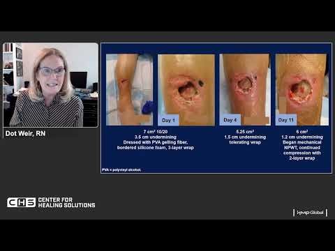 Strategies and Techniques for Managing Complex Wounds using NPWT