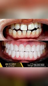 5.8K views |  At our dental clinic, we take pride in providing personalized solutions for patients with missing teeth. Don’t let the absence of teeth stop you from smiling with confidence! With our porcelain veneers, crowns, and bridges, we can restore the natural appearance of your teeth, giving you a radiant and long-lasting smile.醴朗 | Dental Design Smile | Facebook