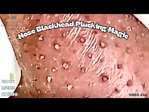 This Nose Blackhead Plucking is Wildly Addictive | Close-Up Extractions + Calming Voiceover | 피지 제거