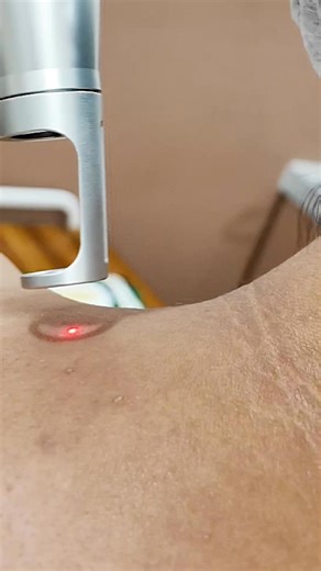 "Say ""Nope!"" to dark nape area with WhiteLase. The creases of fat in the nape area are the main culprit behind darkening nape. WhiteLaser 5G laser is your best bet to even out the skin tone. #FaceForward with every moment here at Mold. Book your WhiteLase 5G laser treatment with Mold Manila. #MoldManila #MoldFromWithin #MoldFace #MoldBody #FaceForwardWithMold" | Mold Manila