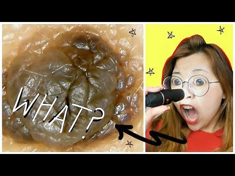 EWW! Acne + Pores Under a MICROSCOPE! (very graphic)