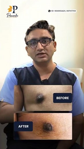 Male Nipple Reduction | Before After Results | Hide Visible Nipples on Your Shirt