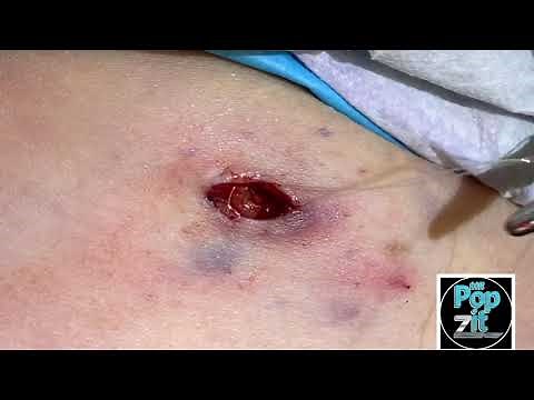 Black coal cyst. Dilated pore of winer. DPOW. Juicy cyst pop. Big squeeze. Old cyst. MrPopZit
