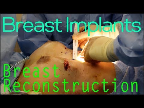Breast Reconstruction - Removal and Replacement of Tissue Expander with Implants and Fat Grafting