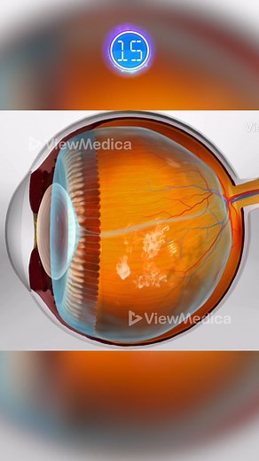 How do eye floaters form? #eye #floaters #medicalanimation #opthalmology | Viz Medical